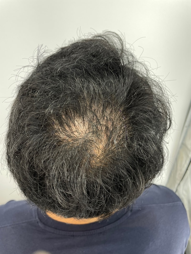 뉴헤어모발 두피문신 찐후기