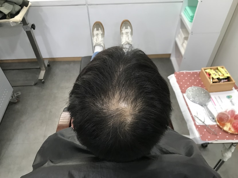 시술 전