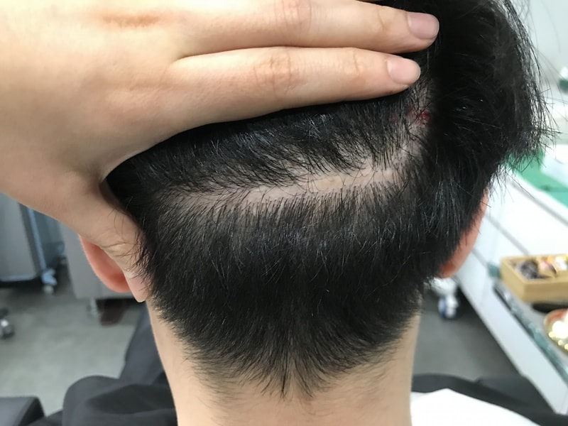 This is the second review of scalp tattoos on hair transplant scars.