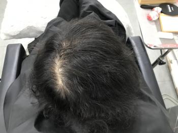 시술전