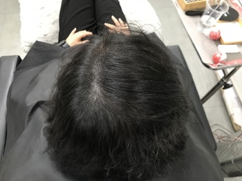 시술 끝나고 머리 말리고 