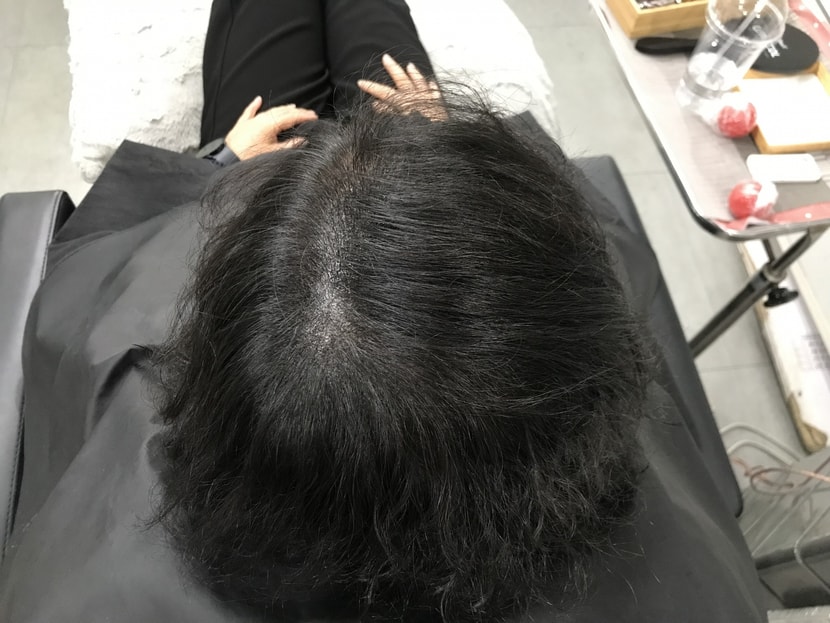 시술 끝나고 머리 말리고 