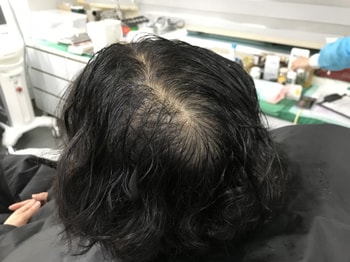 시술전(물묻었을때)