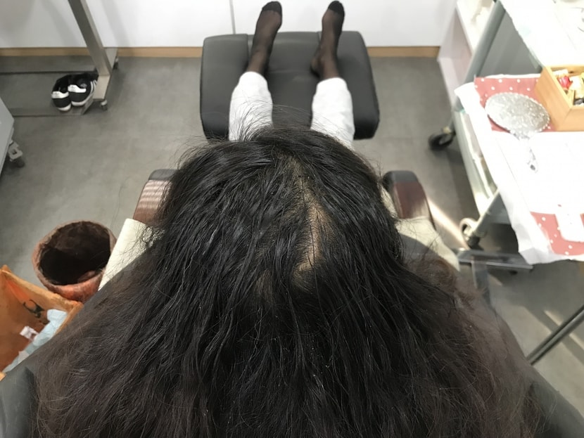 정수리 두피문신 시술전 상태