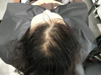 시술전
