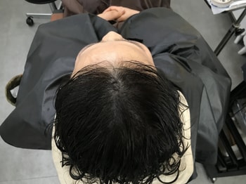 시술후