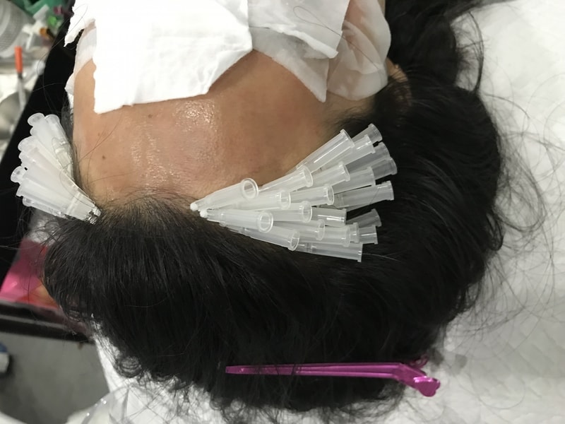 헤어라인 잔머리 재생술 + 정수리 멀티플SMP