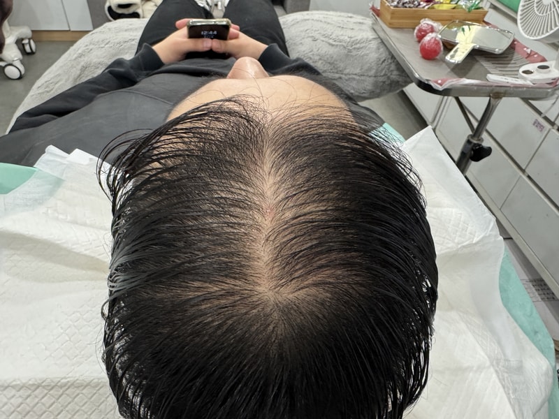 전두부 두피 문신 후기