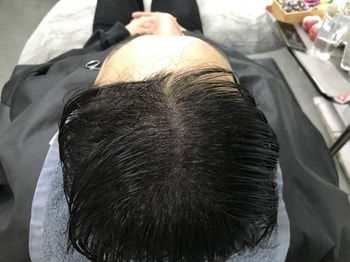 &lt;시술 후&gt;