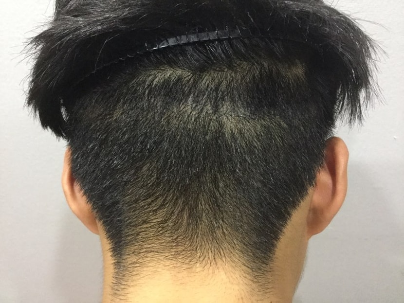 후두부 흉터 시술전