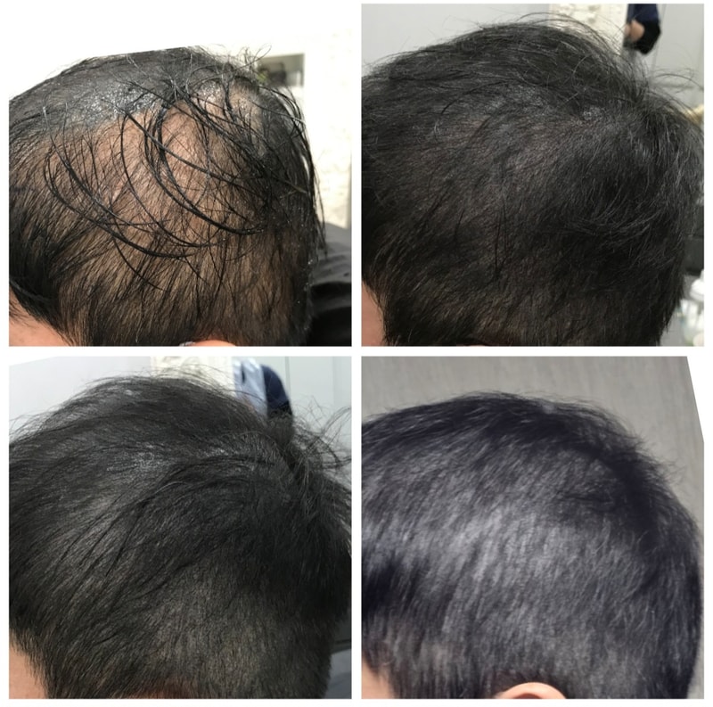 My first retouch after getting a scalp tattoo