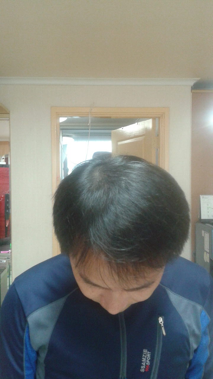 크기변환_1차리터치후1개월 (2).jpg