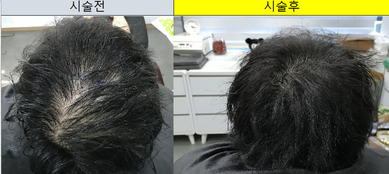 樹脂針微細ドット1次後記