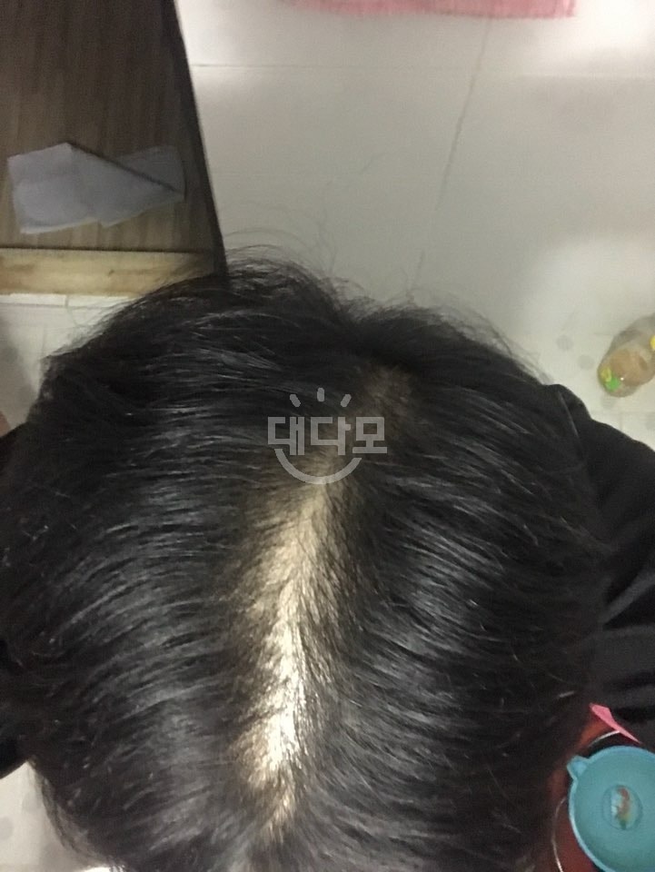 今天头皮纹身了。 是后记第一集