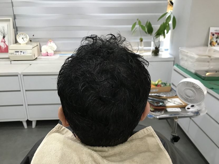 시술 후