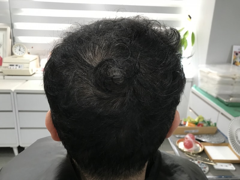 延世ミダイン医院の頭皮タトゥー体験談です。