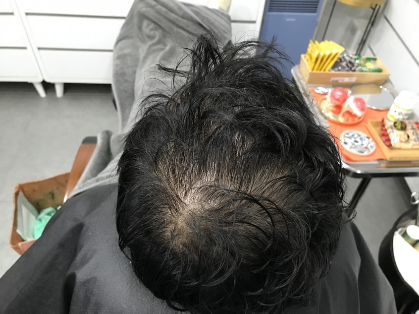 시술 전 &gt; 젖은머리
