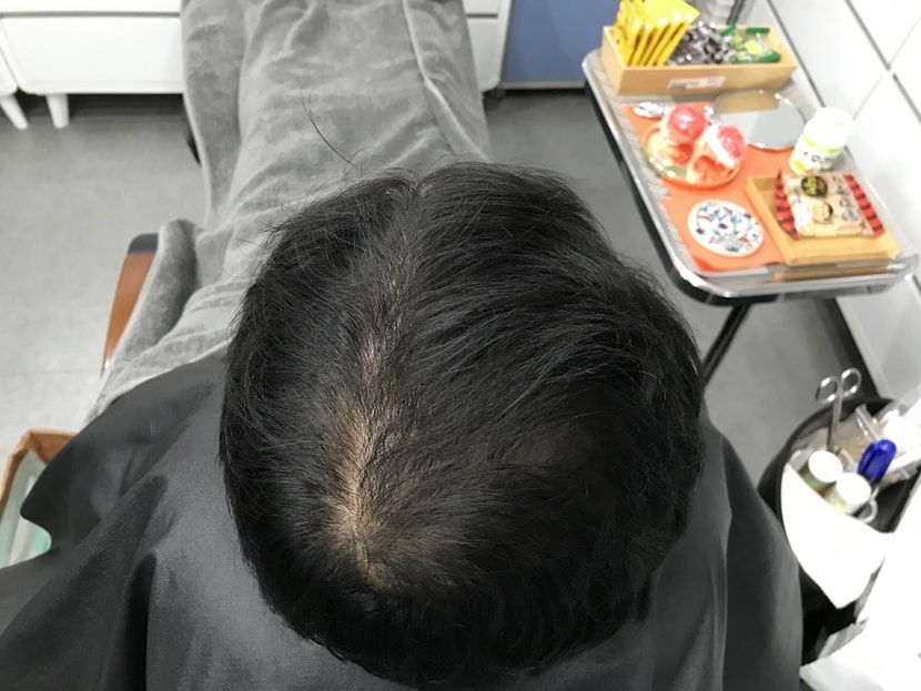  시술 전 &gt; 마른 머리