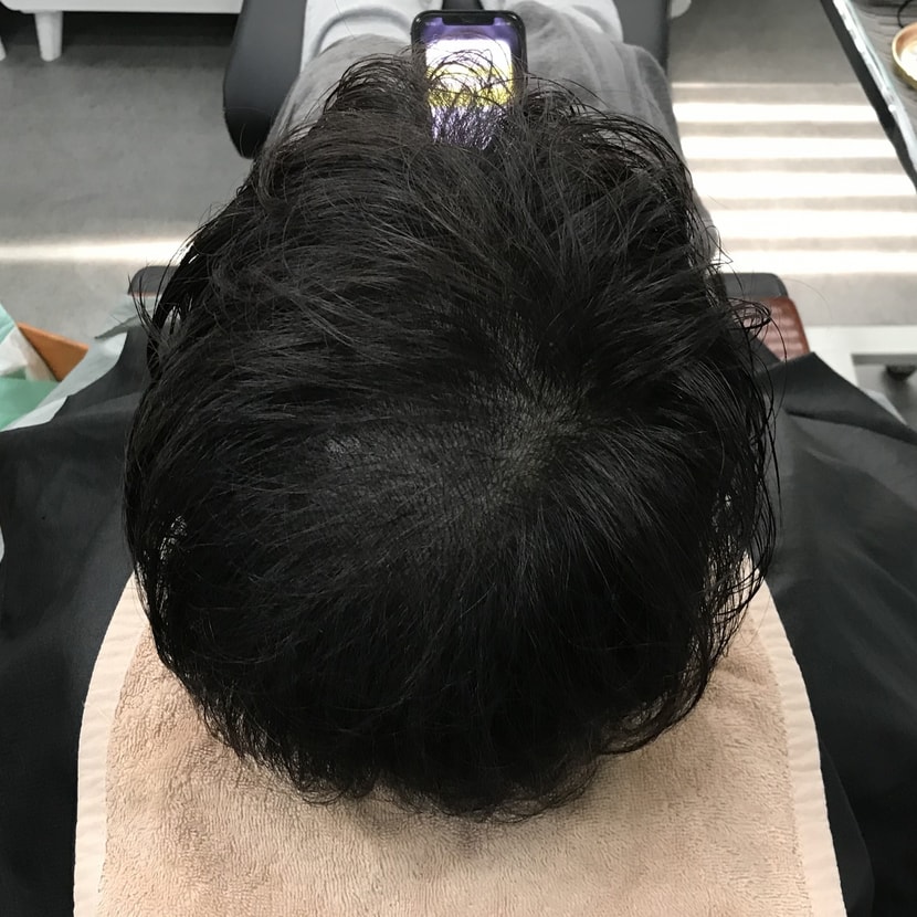 2차 시술 후 