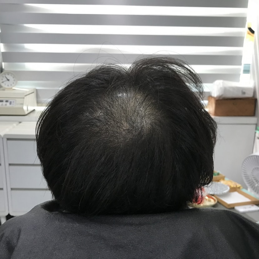 2차 시술 전
