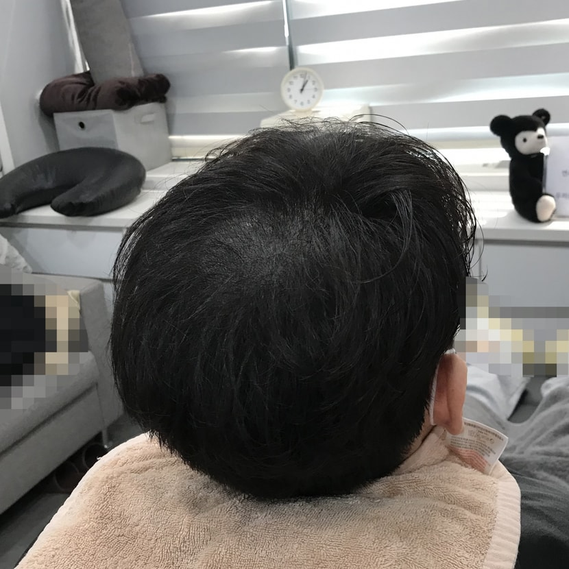 2차 시술 후 