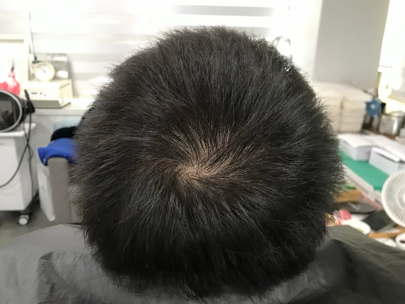 延世大学头皮纹身后期（渐变圆点技法）