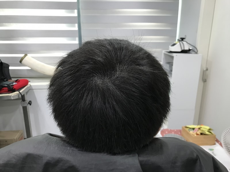 延世美达人头皮纹身修复后记（渐变圆点技法）