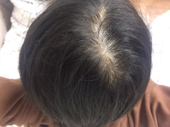 위 두 장은 문신전이에요.. 정수리 부분을 볼 일이 없어서 잘 모르고 살다가 한 번 보고 충갹먹은뒤로 엄청 신경쓰였던 기억이 나네요 ㅜㅜ  이 때는 미녹에 대한 거부감이 있어서  판시딜만 챙겨먹었던 기억이나요 