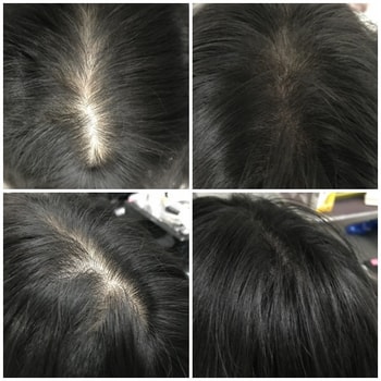 이건 하기 전후사진인데 병원에서 받았던 기억이나네요 ㅜ 만족했었던 기억이 납니다 