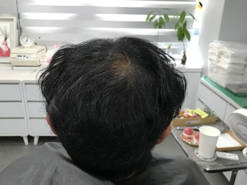 渐变圆点技法头皮纹身第一次后期