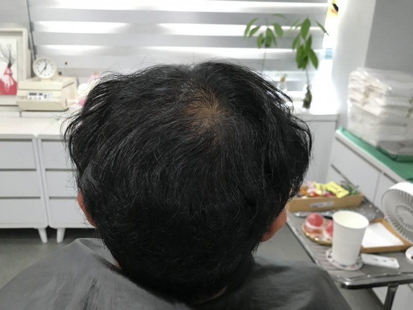 시술전