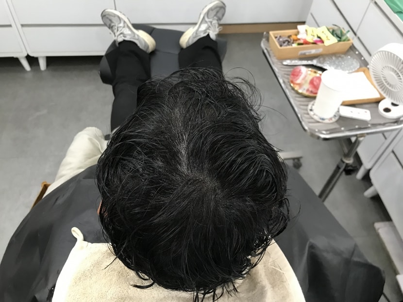 시술후