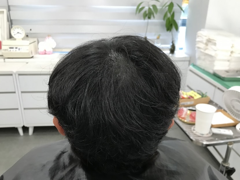 시술후