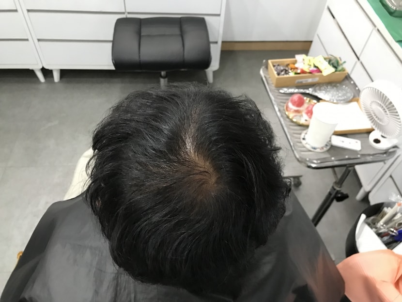 시술후