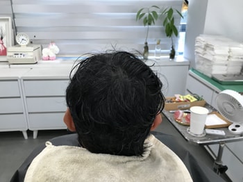 시술후