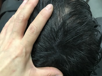 리터치후1