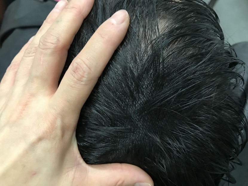 리터치후1