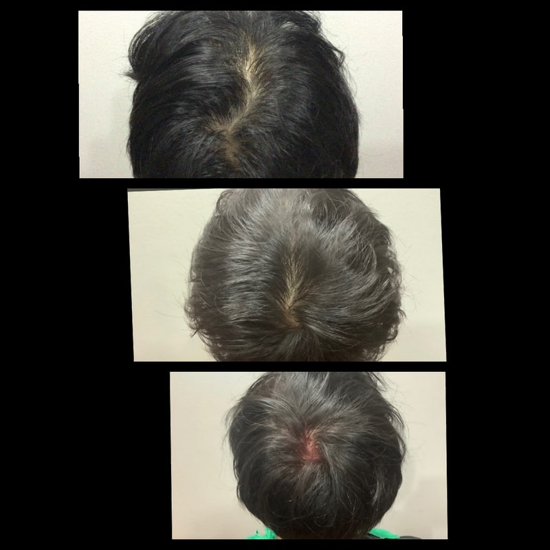 ？？江南米开朗基罗？？？头顶头皮色素管理（smp）手术第2次后期