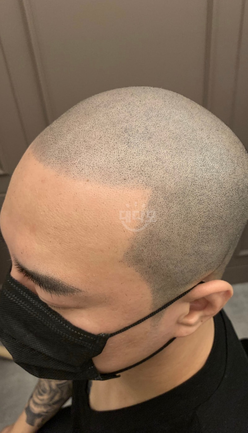 Precise photography and reviews from Gangnam Hair Transplantation to SMP after 8000 Moisture Failure