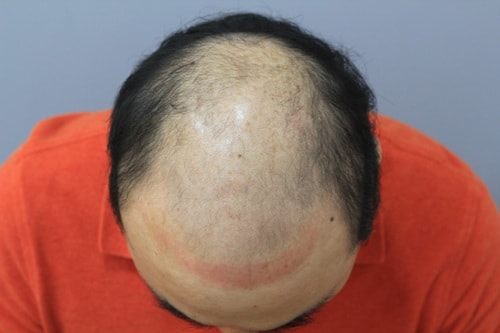 光头皮纹身后记..部位相当大，呵呵。