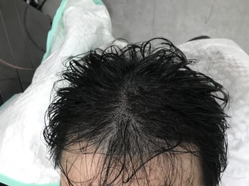 시술 후