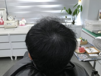 시술 후