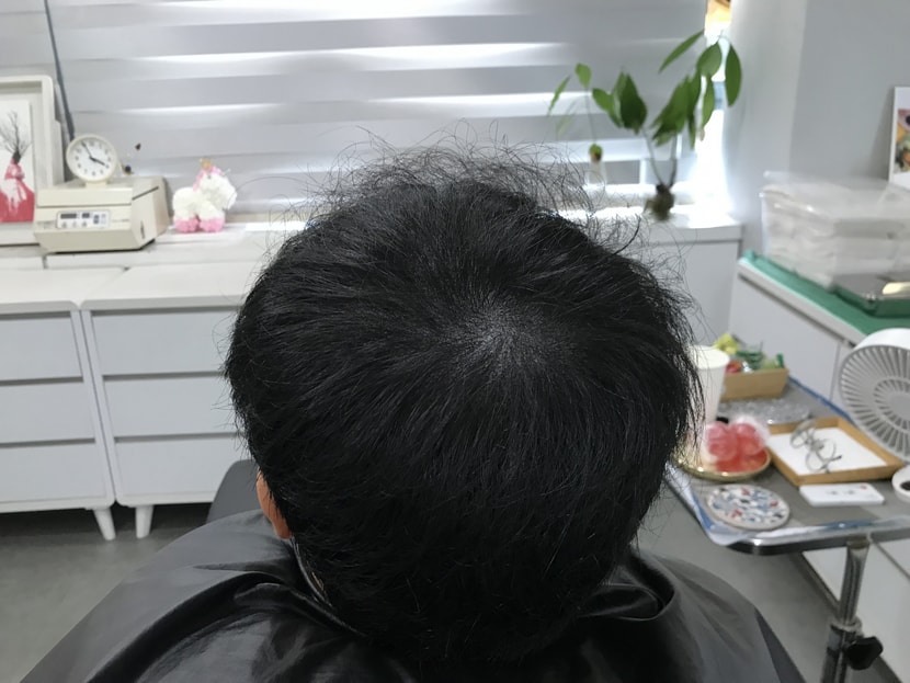 시술 후