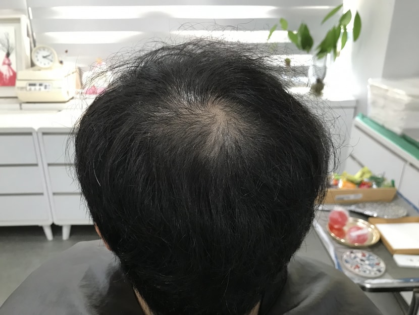 시술 전