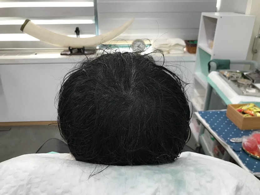 리터치 후