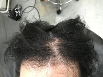 시술 전