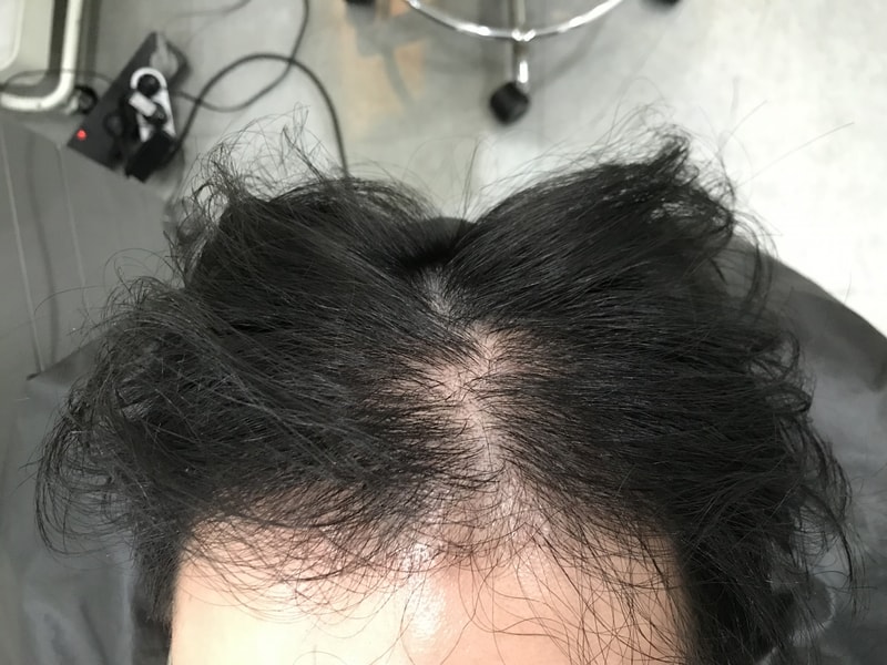 延世ミダイン頭皮タトゥーの2回目の施術レビューです~
