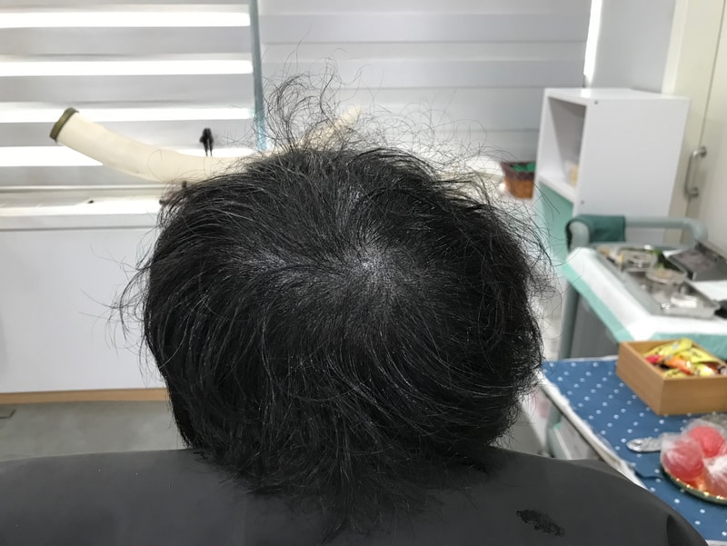 这是延世美人的头皮纹身修复后记~