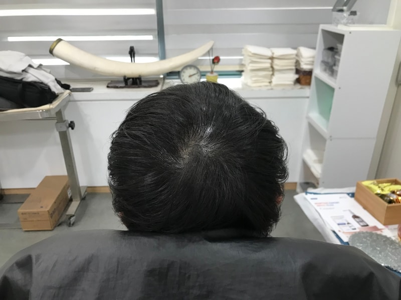 Review of the scalp tattoo retouch