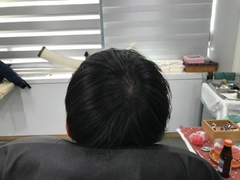 시술후 마른머리
